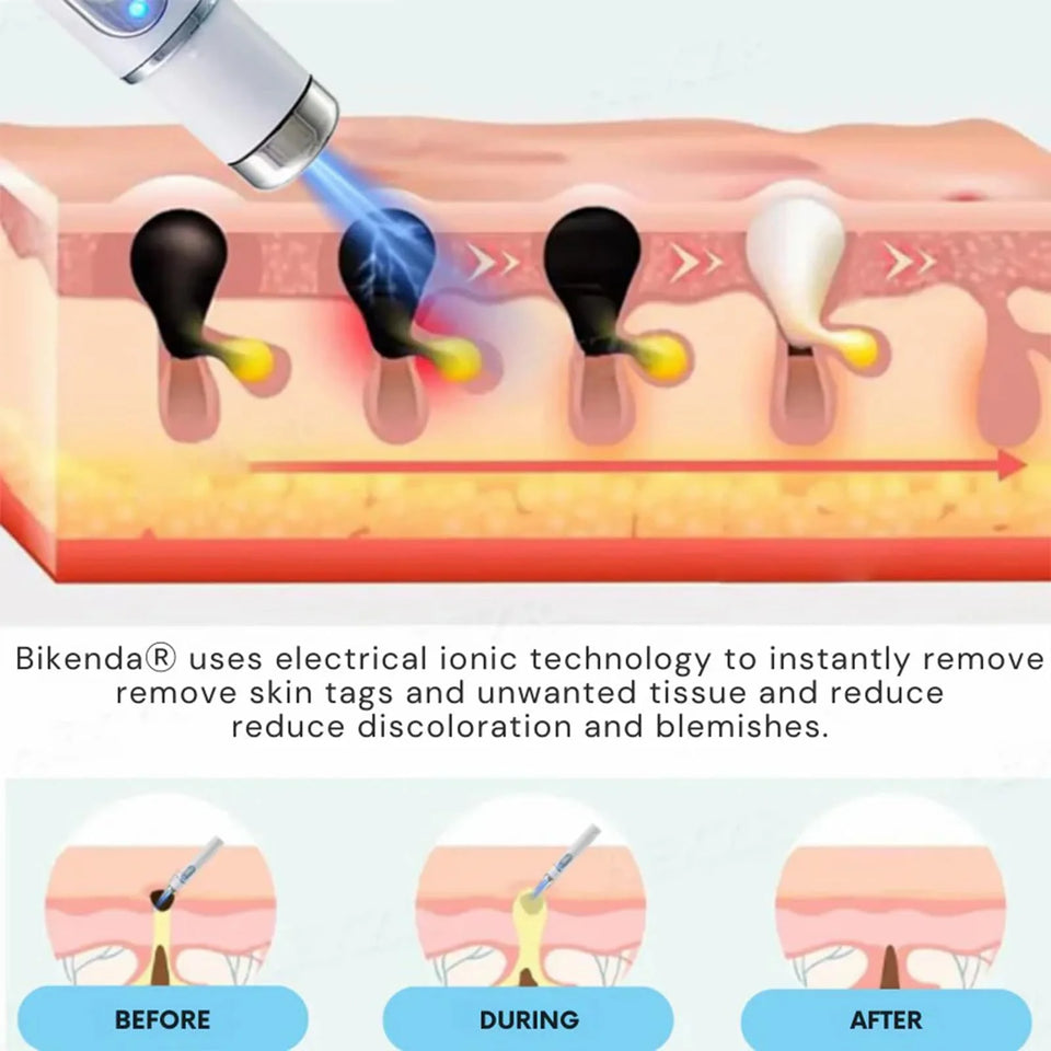 Non-Invasive Mole and Wart Removal Pen