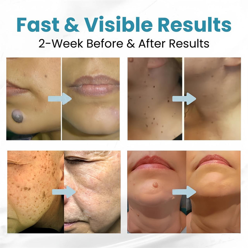 Non-Invasive Mole and Wart Removal Pen