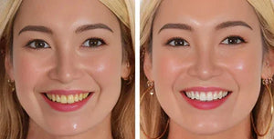 Dazzling Teeth Whitening Pen